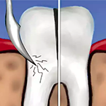 Гемисекция зуба — альтернативный метод сохранения дистальной опоры несъемной ортопедической конструкции
