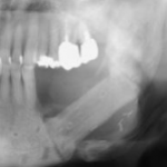 Клинический случай радионекроза челюсти и периимплантита после лучевой терапии