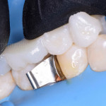 Минимизируем окклюзионные коррекции при реставрации жевательной группы зубов