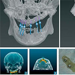 Устранение обширных дефектов челюстей с применением цифрового 3D-планирования