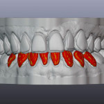 Индивидуальные каппы, напечатанные на 3D-принтере и White Dental Beauty для самой яркой улыбки