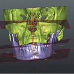 Конусно-лучевая компьютерная томография и 3D-цефалометрия метод изучения черепно- челюстно-лицевых деформаций