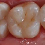 Прямая реставрация боковых зубов. Случай №3