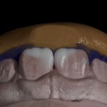 Композитная реставрация постоянных зубов у детей