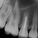 Апексификация несформированного зуба с апикальным периодонтитом и свищевым ходом. Разбор клинического случая