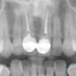Резорбция корня при отбеливании девитальных зубов, или как можно испортить хорошее «эндо»