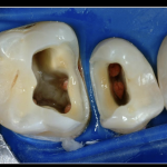 Принятие решений при восстановлении эндодонтически леченных зубов