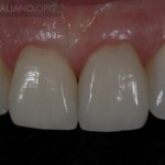 Сила "четырех" и сохранение тканей зубов