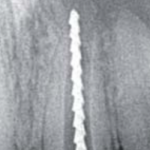 Применение операционного микроскопа при повторном эндодонтическом лечении зубов с незавершенным формированием корней