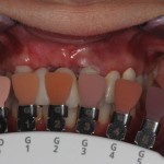 Повторная эстетическая реабилитация зубов после травмы