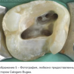 MB2 в верхних молярах - как определить его наличие в зубе