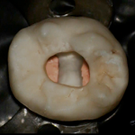 Выбор подходящего композита и техники послойного внесения для восстановления эндодонтически леченного зуба