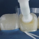Глубокая полимерная инфильтрация для консервативного лечения центрального резца, пораженного моляро-резцовой гипоминерализацией