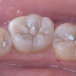 Творческий подход к восстановлению нескольких боковых зубов