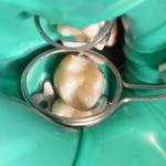 Особенности эстетико-функциональной реставрации зубов