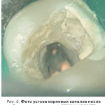 Клинический случай: второй премоляр нижней челюсти с тремя корневыми каналами