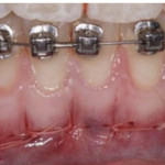 Ортодонтическое лечение при помощи пьезоцизии с применением индивидуализированных ортодонтических аппаратов, изготовленных по методу CAD/CAM: рандомизированное контролируемое исследование взрослых пациентов