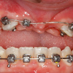 Междисциплинарное лечение пациента с ретенцией зубов