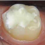 Сравнительная характеристика эффективности использования стеклоиономерных цементов в клинике стоматологии детского возраста