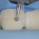 Невидимая линия перелома после фиксации фрагмента зуба