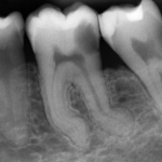 Разведка корневого канала зуба, эндодонтия