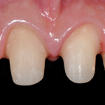 Препарирование зуба с формированием уступа