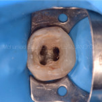 Эндодонтическое перелечивание первого моляра нижней челюсти с пропущенным серединным мезиальным каналом