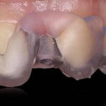 Цифровой протокол восстановления отсутствующего 22 зуба и шиповидного 12