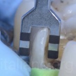 Клинический случай прямой композитной реставрации жевательных зубов
