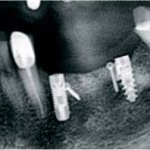 Комбинация  методов  аугментации костной ткани при установке дентальных имплантатов на нижней челюсти