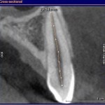 Компьютерная томография в эндодонтии: образец современного лечения