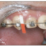 Уровень субстанции P в десневой жидкости у пациентов, проходящих ортодонтическое лечение на брекет-системе Damon