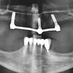 Полное восстановление зубных рядов с помощью несъёмных протезов, фиксированных на имплантатах