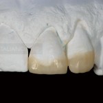 Композитные накладки на передние зубы (клинический случай с 10-летним наблюдением)