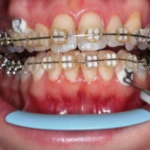 Dentograf. Применение оборудования нового поколения для функциональной диагностики