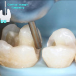 Прямая композитная реставрация жевательной группы зубов: метод StyleItaliano