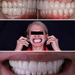 Комплексная реабилитация на зубах и имплантатах