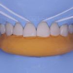 Постортодонтическое удлинение резцов с помощью прямой реставрации