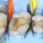 Восстановление контактного пункта в прямой композитной реставрации боковых зубов