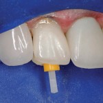 Экстренное восстановление фронтального зуба после неудачного лечения