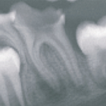 Реакция пульпы и периапикальных тканей на глубокий кариес в несформированных зубах: гистологическое и гистобактериологическое исследование