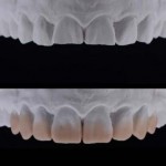 Реставрация зубов с повышенной стираемостью композитными накладками
