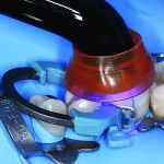 Bulk-fill композитные реставрации жевательных зубов