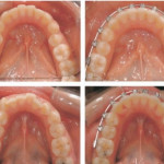 Сравнение самолигирующих и традиционных лигатурных брекетов в лечении скученности зубов нижней челюсти: клиническая оценка продолжительности лечения и достигнутых результатов
