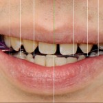 Digital Smile Design: восстановление эстетики улыбки с сохранением максимального объема здоровых тканей зубов