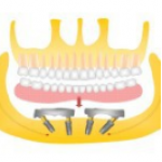 Реабилитация пациентов с тотальным отсутствием зубов съемными протезами с опорой на балочную конструкцию
