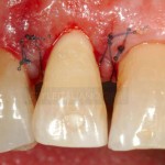Горизонтальный перелом зуба, протокол лечения