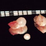 Лечение патологий пародонта, спровоцированных эмалевыми жемчужинами