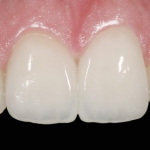Восстановление утраченных тканей в стоматологии
