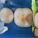 Лечение глубокого кариеса боковых зубов, пошаговый протокол